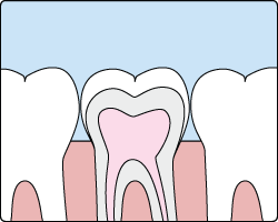 animation illustrating the application of a dental sealant